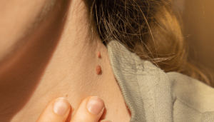 Skin tag