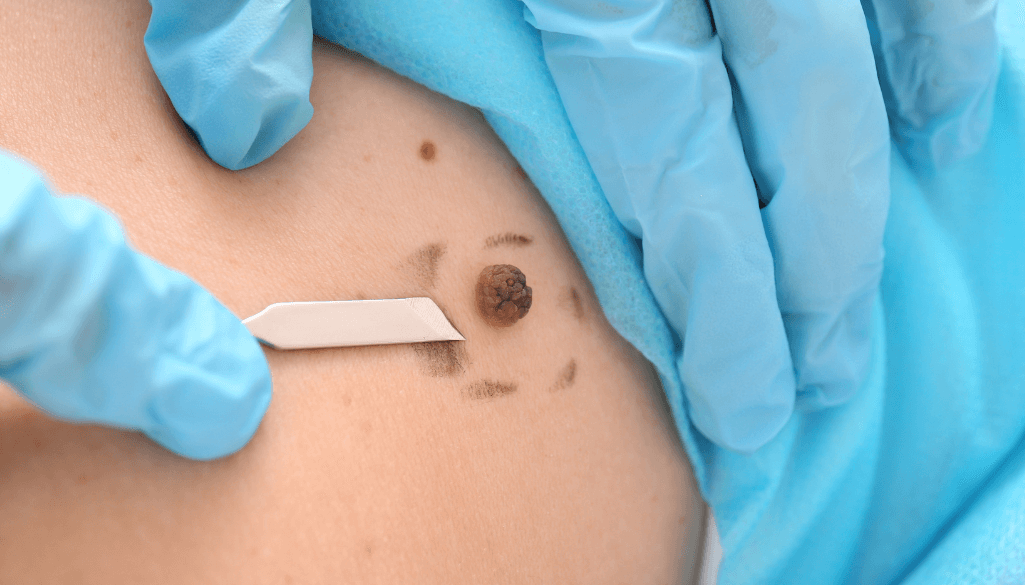 How To Remove Skin Tags? Explore the Effective Ways