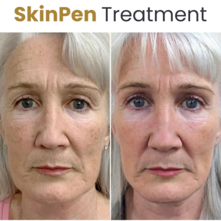 Skinpen treatment before and after