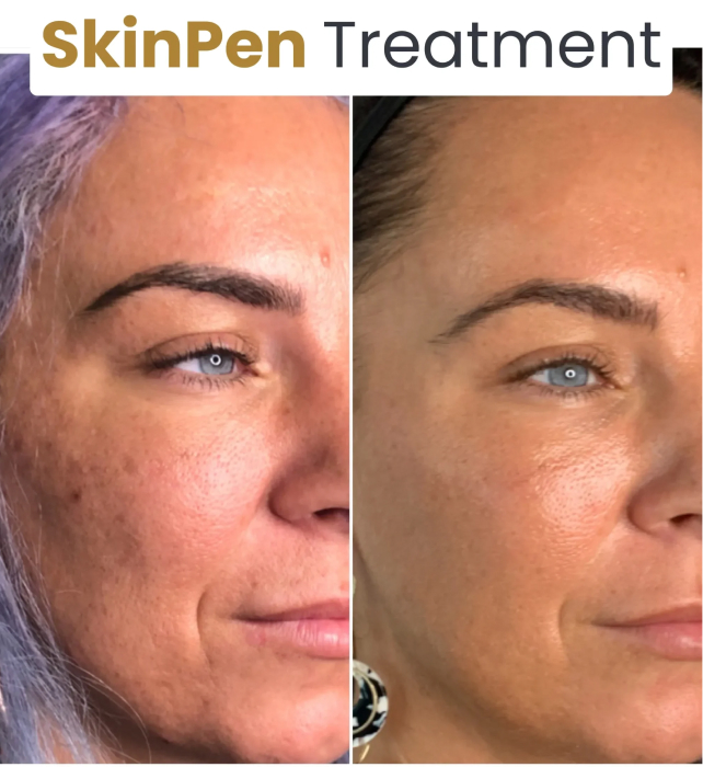 Skin Pen Microneedling 15 Skinpen 3 scaled e1702652582125 1 2