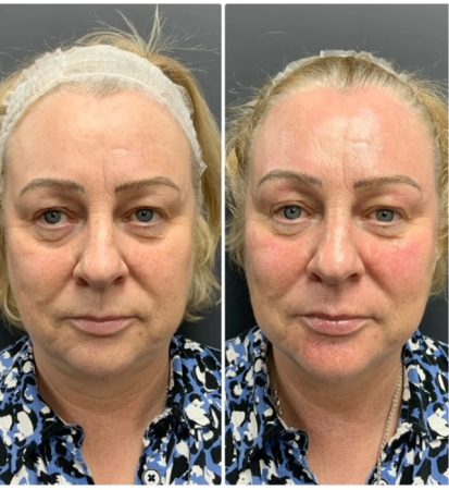 SkinPen Microneedling 171 before and after