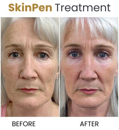 SkinPen Microneedling 169 Skinpen 3 scaled e1702652582125 1