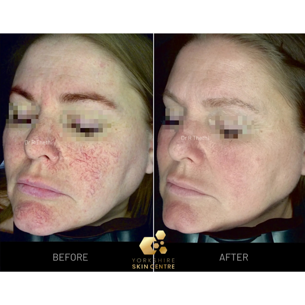 ThermVein before and after result