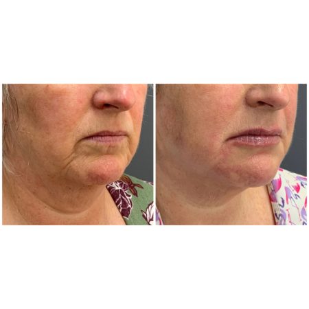 Lip Filler Before and after result