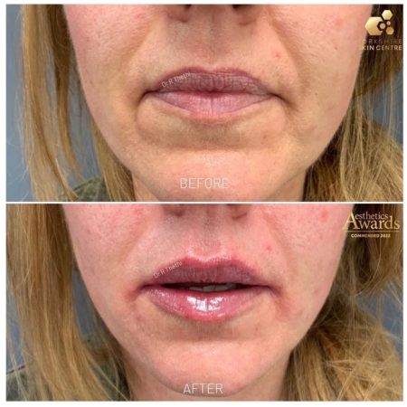 Lip Filler before and after