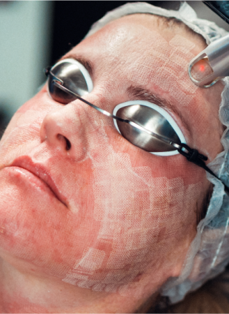 Signature Lift 53 YSC Signature Lift Treatment