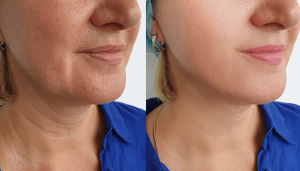 How to get rid of turkey neck? 5 Effective Tips