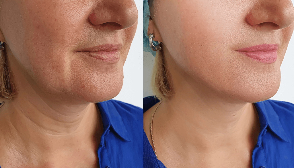 How to Get Rid of Turkey Neck? 5 Effective Tips