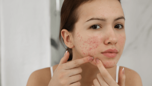 Acne Scars
