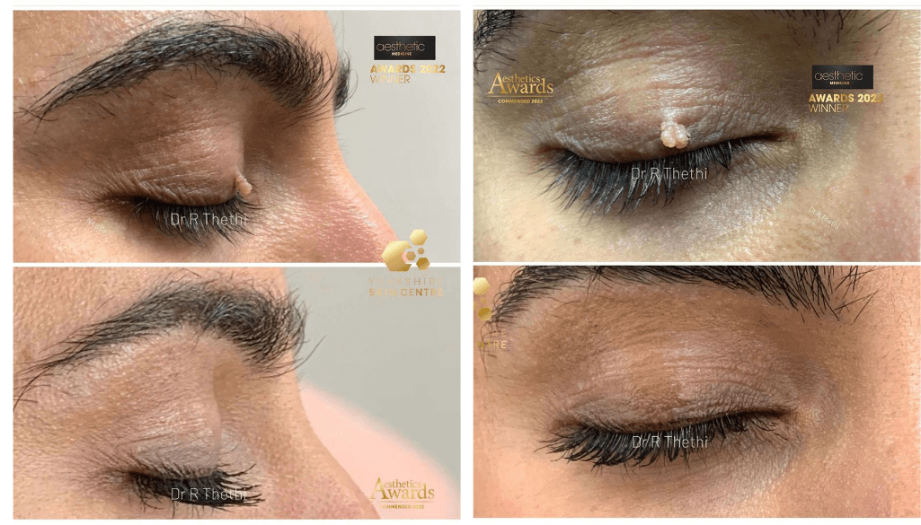 How to Remove Moles from Face: A Complete Guide