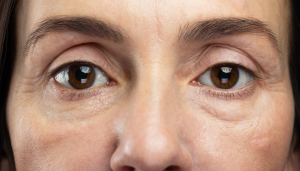 what causes bags under eyes