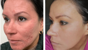 How to Get Rid of Acne Scars