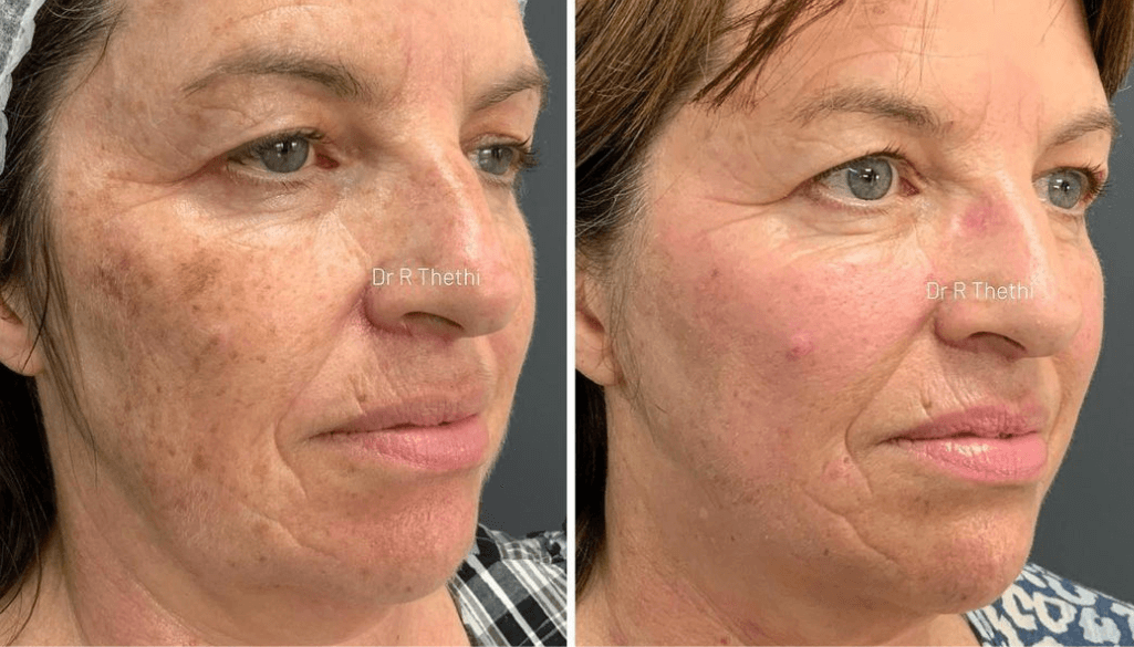 How To Remove Dark Spots On Face? 9 Quick Medical Tips