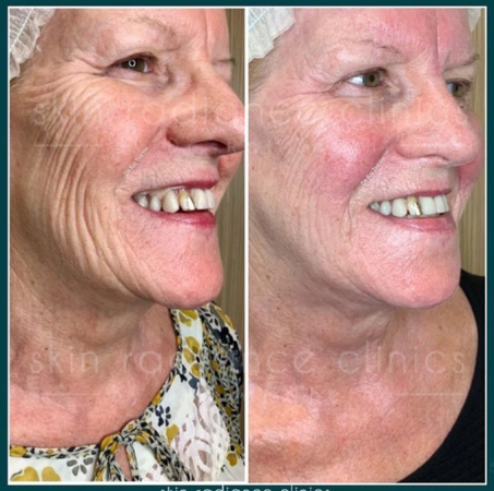 ChemicalPeelBF2 1 2 1