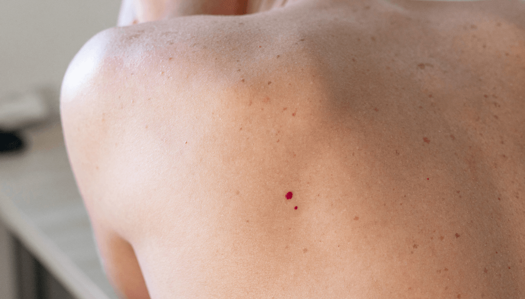 Cherry Angiomas: Causes, Removal Methods & FAQs