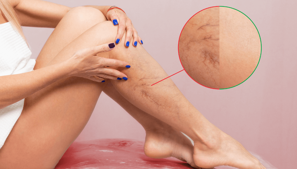 How To Get Rid Of Spider Veins? Top 6 Professional Treatments