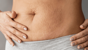 How to Remove Stretch Marks Permanently