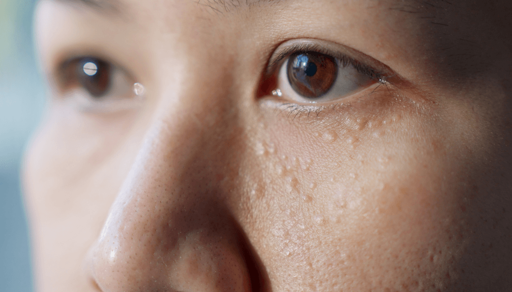 How to Get Rid of Milia: Proven At-Home and Professional Treatments