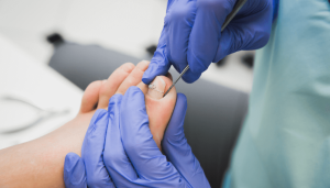 Most Effective Treatment for Toenail Fungus