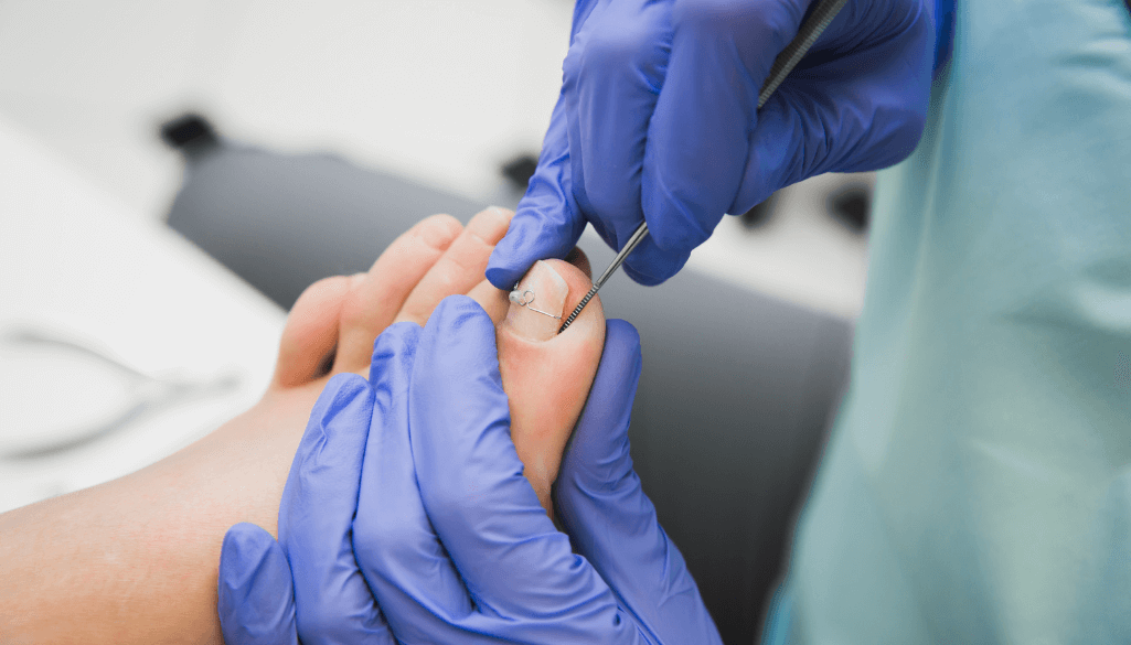 What is the Most Effective Treatment for Toenail Fungus?