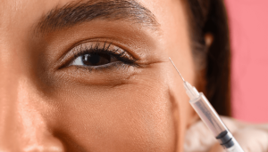 Tear Trough Filler Gone Wrong