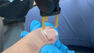 What Kills Toenail Fungus Instantly