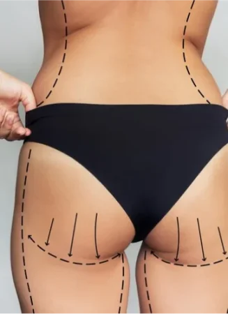 fat dissolving injections1