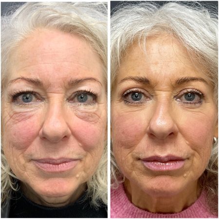 Lower Blepharoplasty 13 lowerBleph1