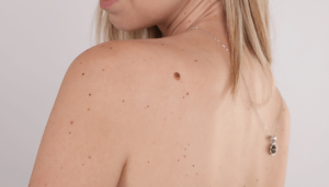 Why Am I Getting Skin Tags All Of A Sudden