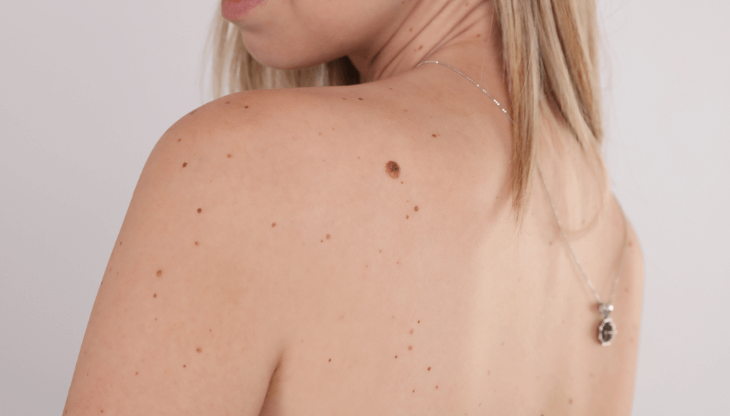 Why Am I Getting Skin Tags All Of A Sudden? 