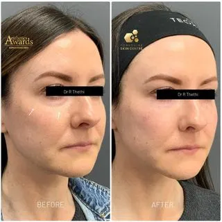 Tear Trough Fillers 99 Cheek & tear trough filler before and after result