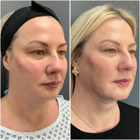 Signature Lift 61 IMG 3522