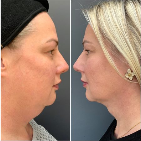 Signature Lift 62 IMG 3523