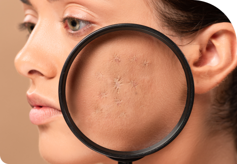 Scar Revision 108 Improves Scar