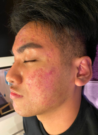 Scar Revision 93 Scar Revision