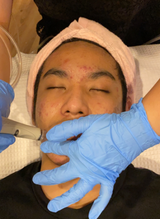 Scar Revision 94 Scar Revision1