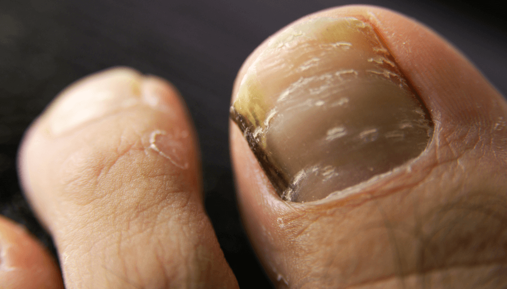 Different Types of Toenail Fungus and How to Identify Them