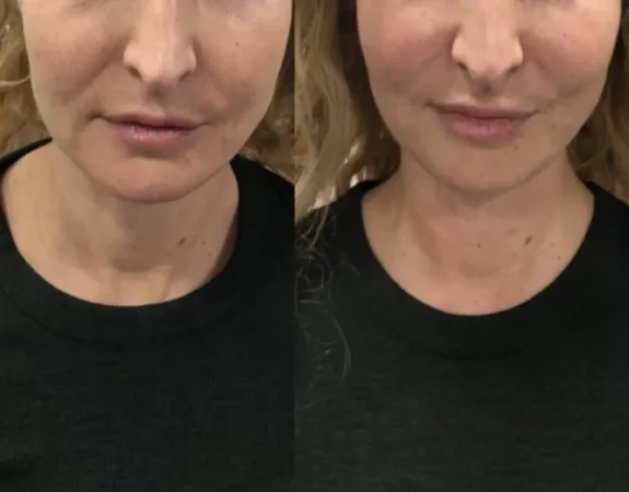 Forma Plus 120 forma skin tightening before and after patient 1