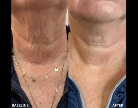 Forma Plus 116 forma skin tightening before and after patient 3