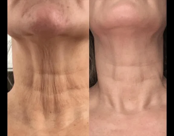 Forma Plus 117 Forma Skin Tightening Before and after Patient 4