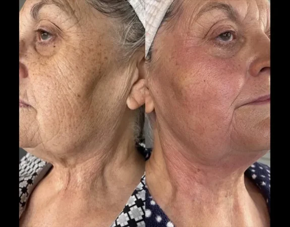 Forma Plus 118 forma skin tightening before and after patient 5