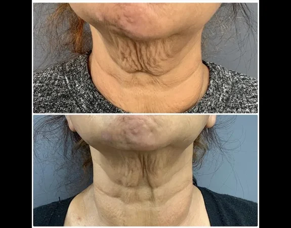 Forma Plus 119 forma skin tightening before and after patient 6