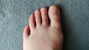 Signs that toenail fungus is dying