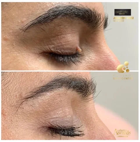 Mole Removal 15 skin tag removal before and after