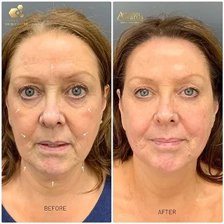 Forehead Filler 15 forehead filler before after1