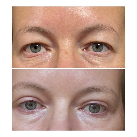 upper blepharoplasty