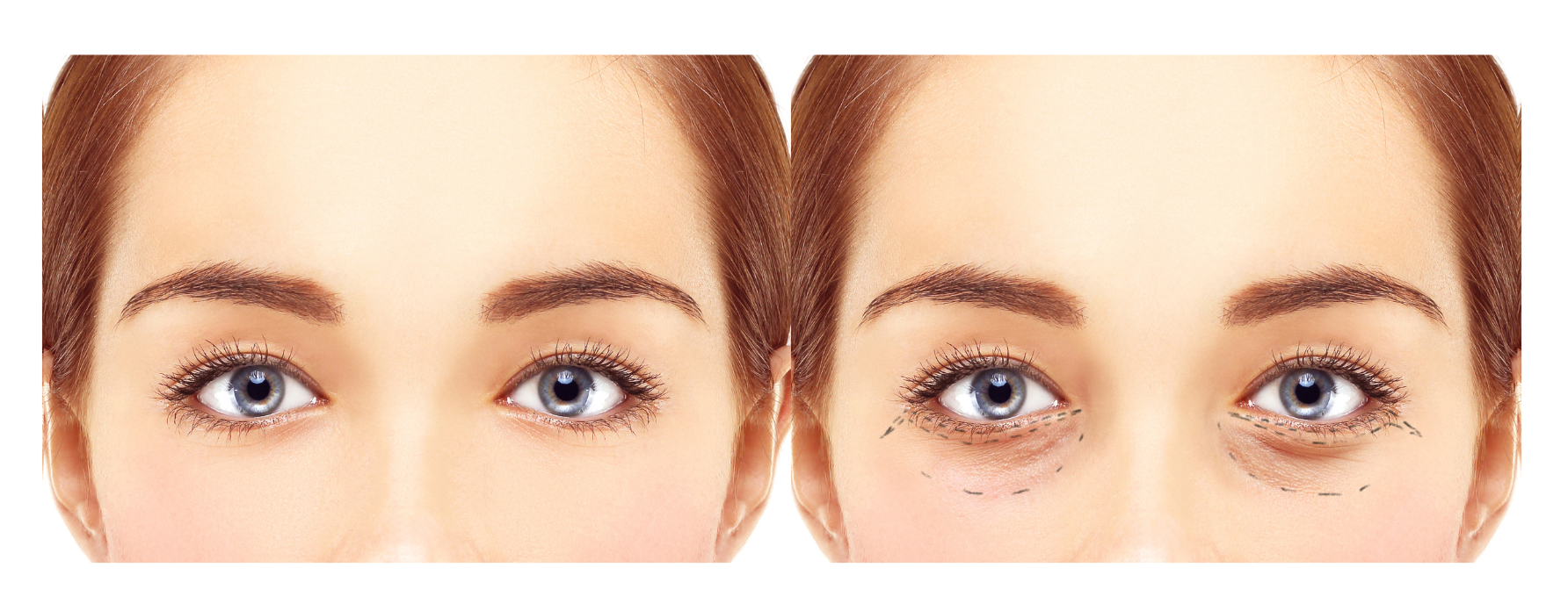 Blepharoplasty Gone Wrong before after2