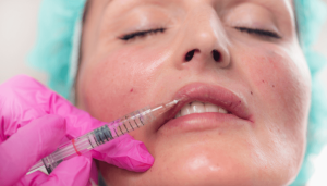 lip filler migration