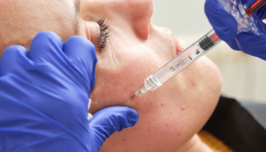 How Long Do Cheek Fillers Last