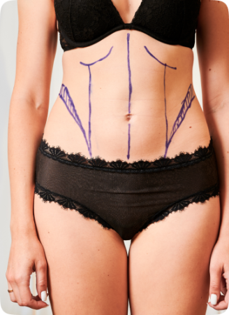 bodyjet liposuction1